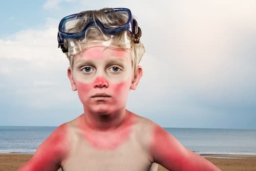 boy with painful sunburn